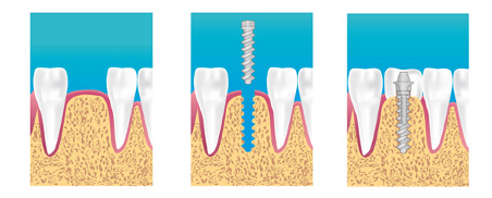 implant dentaire cagnes sur mer